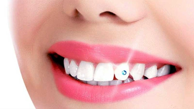 Cosmetic Dentistry Smile Makeover with Tooth Jewel Crystal