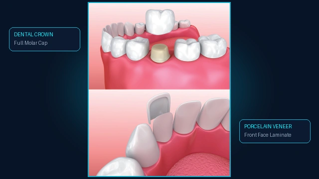 Dental Crown and Porcelain Laminate Veneer Placement
