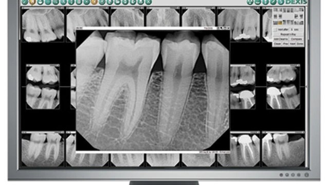 Digital Dental X-Ray Diagnostic Radiographs on High Resolution Screen