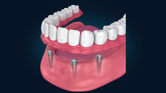 Implant Supported Prosthesis and Titanium Roots