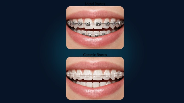 Metal Braces and Clear Ceramic Braces Comparison on Teeth