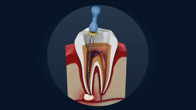 Endodontic Rotary Root Canal Procedure Cleaning Infected Pulp