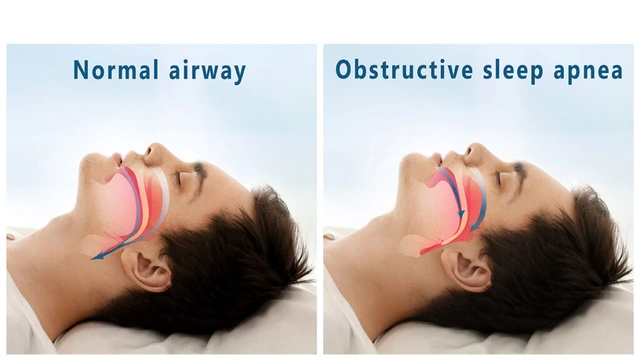Normal Airway vs Obstructive Sleep Apnea Airway Comparison