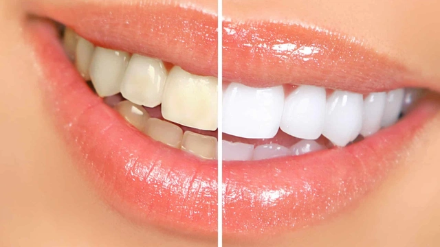 Professional Teeth Whitening Before and After Smile Comparison