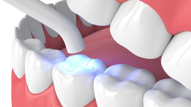 Tooth Coloured Composite Resin Filling Curing Light Procedure